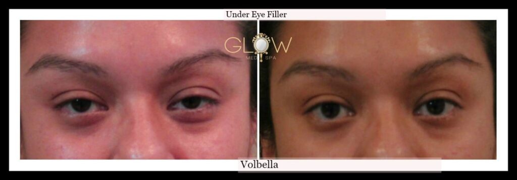 Undereye Filler using Volbella