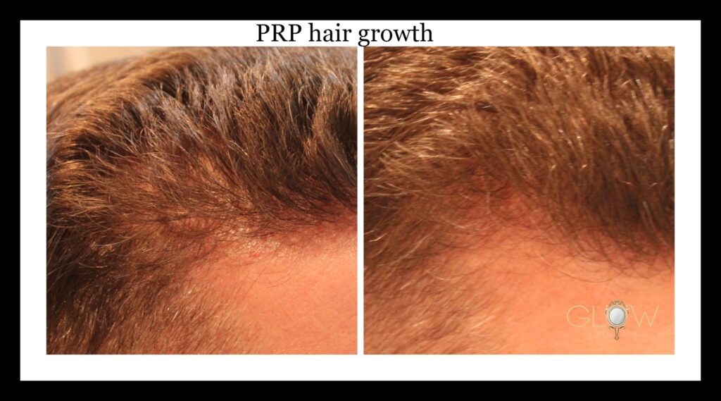 PRP Hair Growth Encino