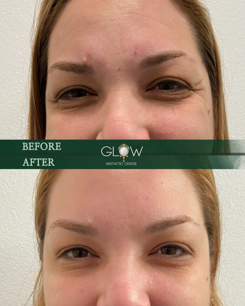 Before and after image showcasing the skin improvement of a female client at Glow Aesthetic Center, highlighting reduced blemishes and smoother skin texture.