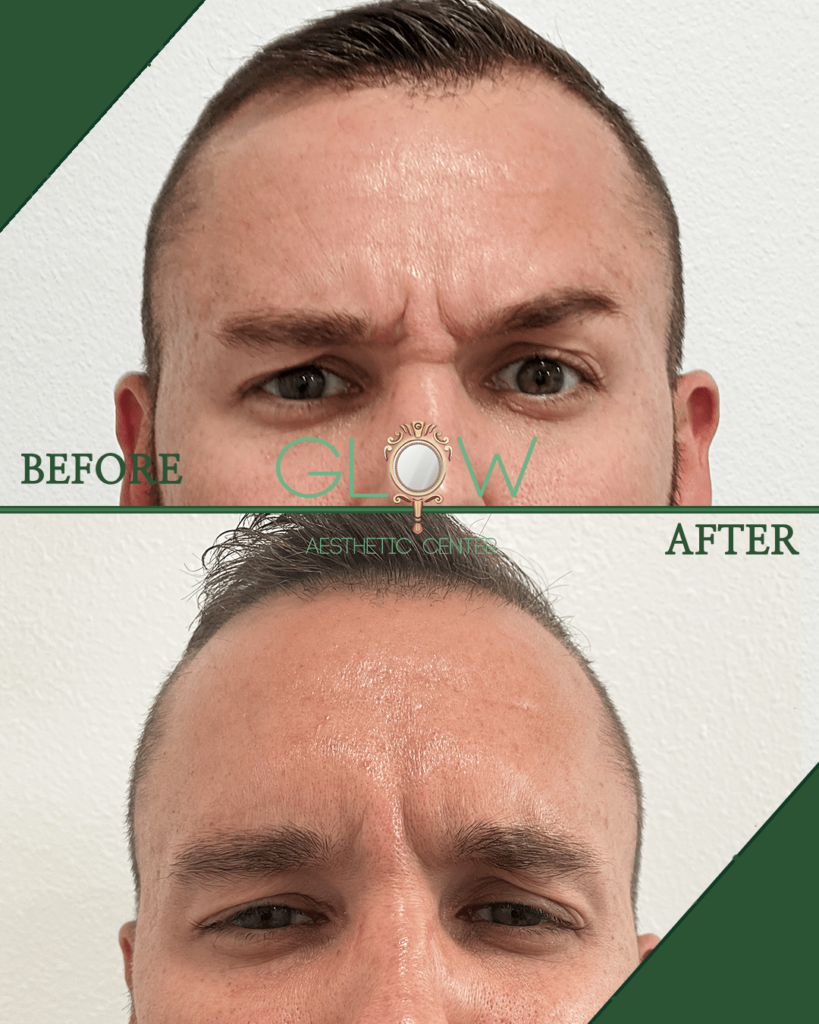 Before and after comparison of a male client showing the effects of a cosmetic treatment at Glow Aesthetic Center, highlighting reduced forehead wrinkles and improved skin texture.