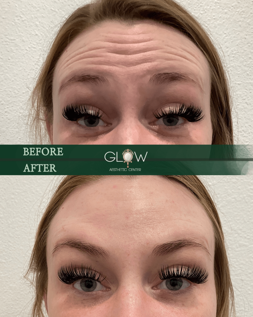 Before and after image showcasing eyelash enhancements at Glow Aesthetic Center, highlighting the transformation with fuller, longer lashes and improved eye appearance.