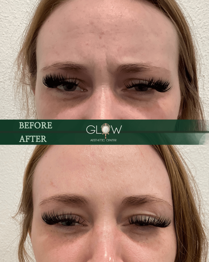 Before and after comparison of eyelash extensions at Glow Aesthetic Center, showcasing enhanced volume and length in the after image. The subject displays fuller, more defined lashes, highlighting the transformative effects of the treatment.
