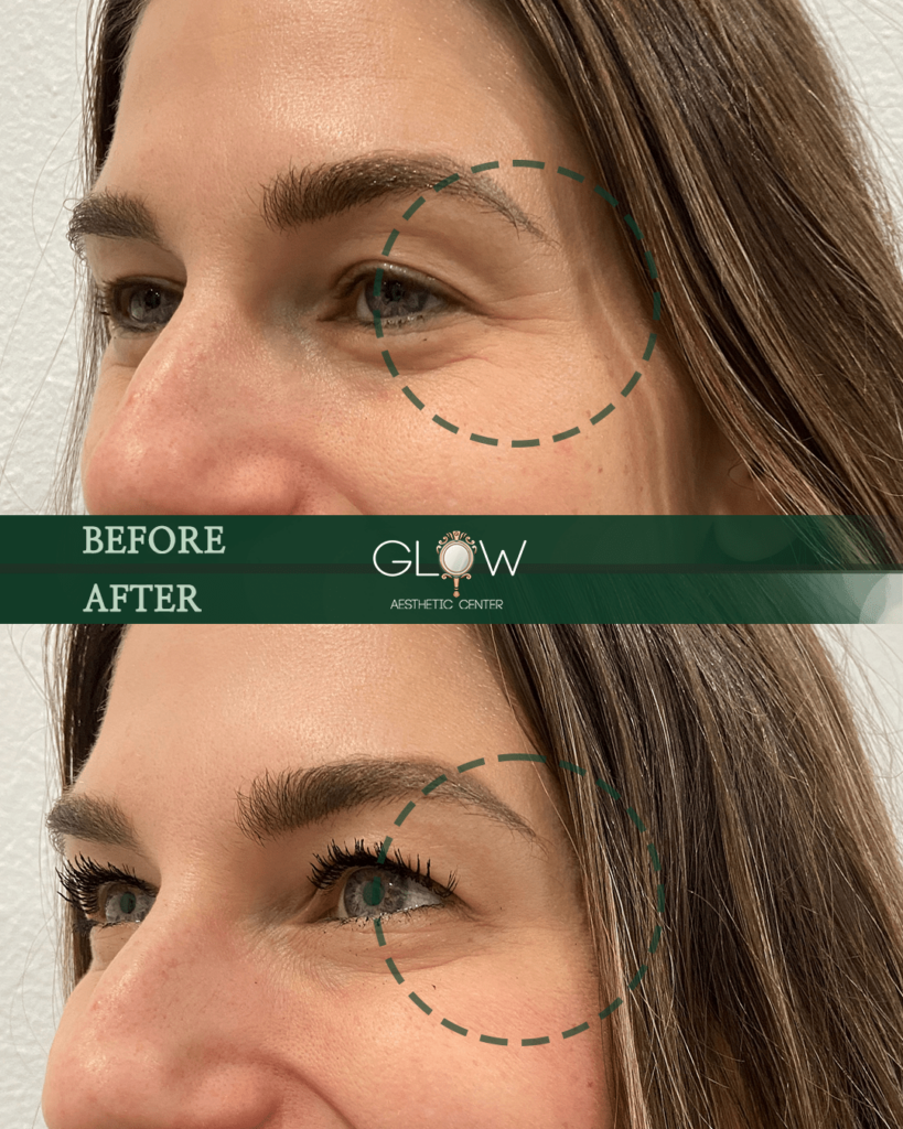 Before and after image showcasing the results of an aesthetic treatment at Glow Aesthetic Center, highlighting reduced fine lines around the eyes and enhanced eyelash appearance.