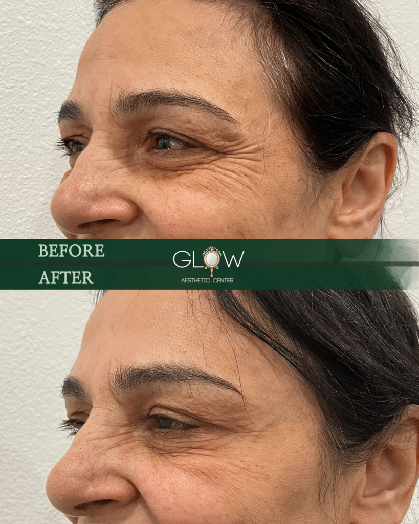 Before and after image showcasing the results of an aesthetic treatment at Glow Aesthetic Center, highlighting improved skin texture and reduced wrinkles around the eyes.