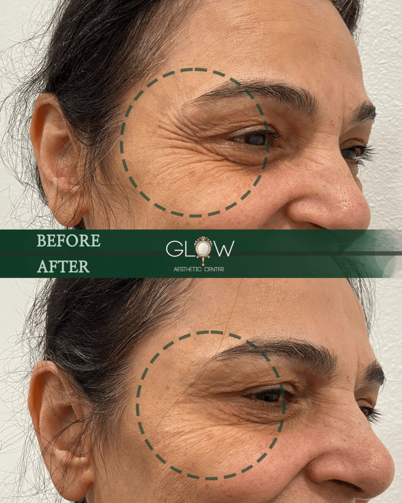 Before and after image showcasing the results of an aesthetic treatment at Glow Aesthetic Center, highlighting significant reduction in wrinkles around the eyes and forehead.