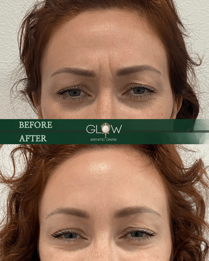 Before and after comparison of a woman's forehead showing reduced wrinkles and smoother skin, highlighting the results of aesthetic treatments at Glow Aesthetic Center.