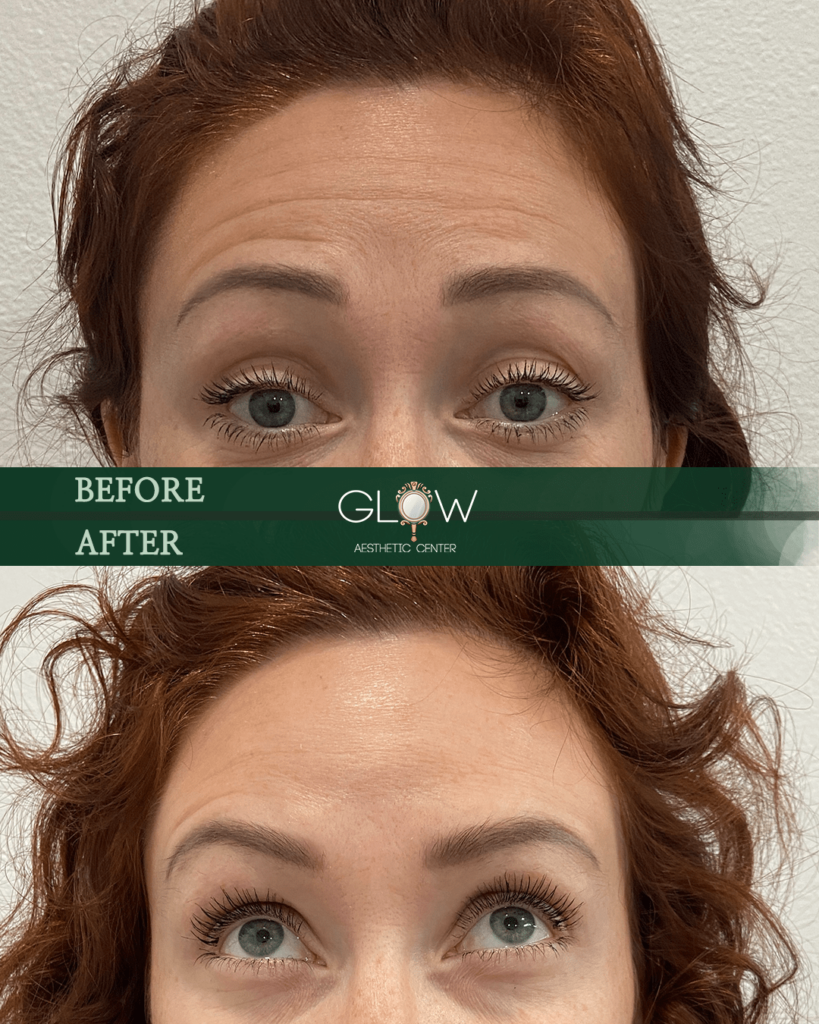 Before and after transformation showcasing eyelash enhancement at Glow Aesthetic Center, highlighting improved lash length and volume in a client with red hair and green eyes.