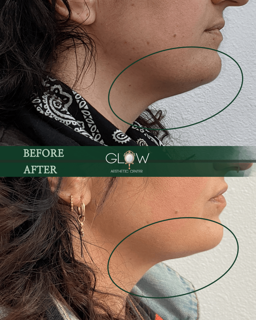 Before and after comparison showing chin enhancement results at Glow Aesthetic Center, highlighting improved jawline contour and reduced double chin appearance.