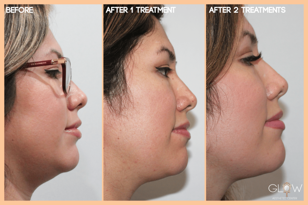 Before and after images showcasing the results of aesthetic treatments on a woman's profile, highlighting improvements in facial contour and skin texture after one and two treatments.