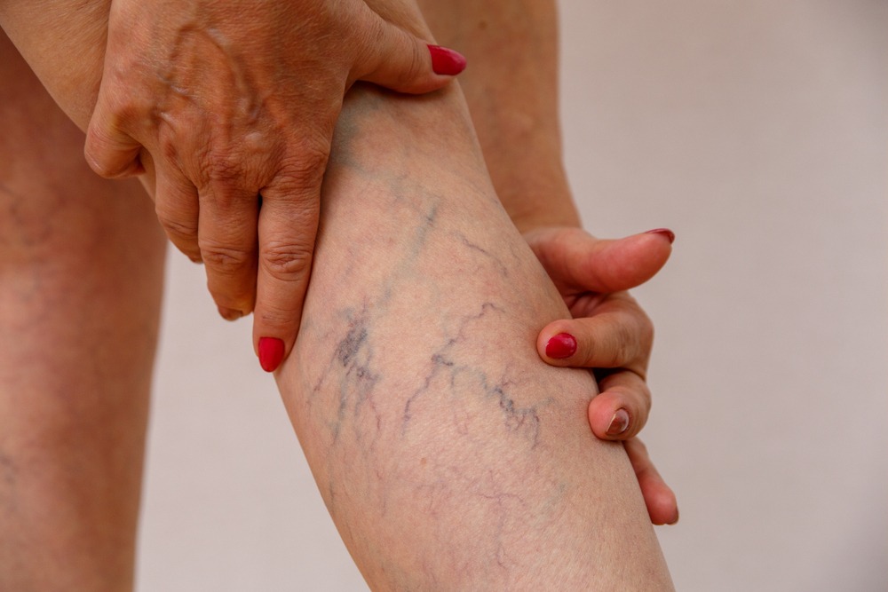 Close-up of a person's hand examining varicose veins on the leg, highlighting the bluish, swollen veins and skin texture. The image emphasizes the appearance of vascular issues, commonly associated with aging or poor circulation.