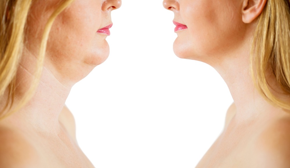 Before and after image showcasing the profile of a woman highlighting the reduction of a double chin, emphasizing improved jawline definition and facial contour.