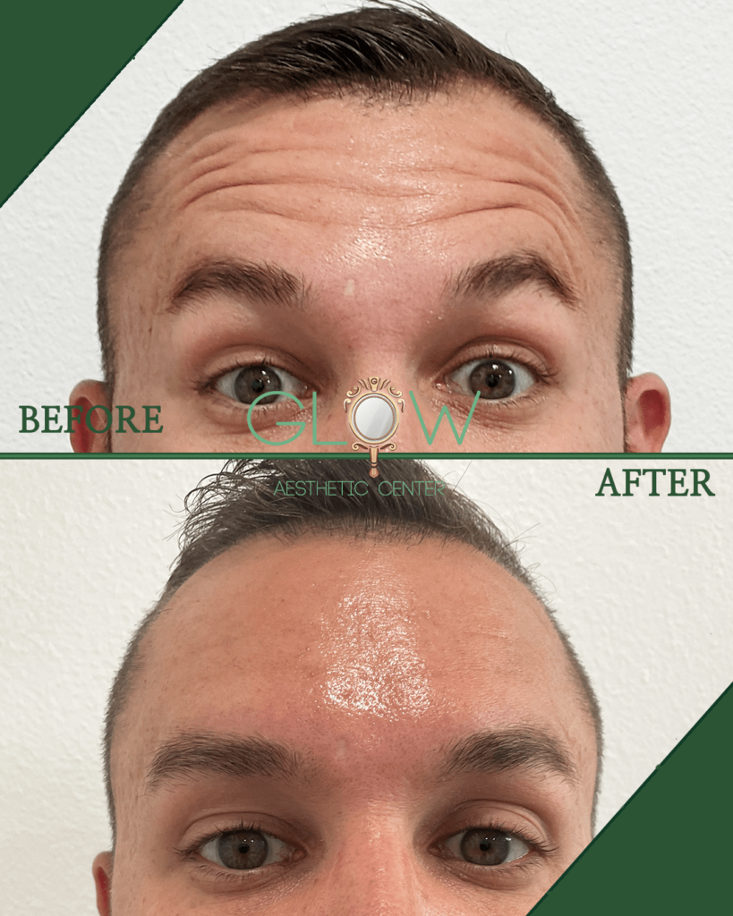 Before and after photo showcasing the results of an aesthetic treatment on a male client at Glow Aesthetic Center, highlighting improved skin texture and appearance.