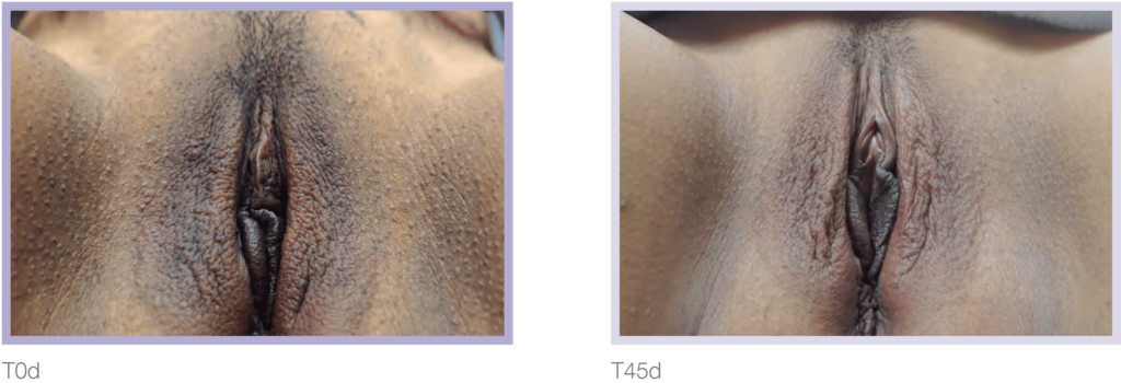 Close-up images of vulvar anatomy showing two different views labeled T0d and T45d, highlighting variations in texture and appearance. These images are used for educational purposes in the study of human anatomy and reproductive health.