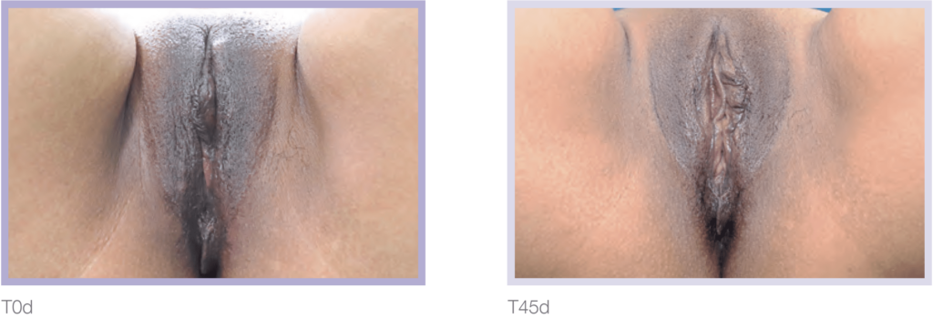 Medical comparison of two anatomical images labeled T0d and T45d, showcasing variations in appearance and structure.