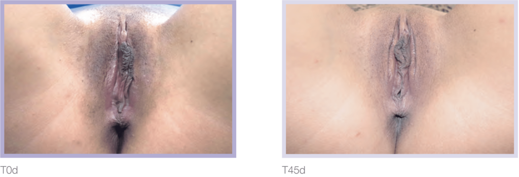 Side-by-side comparison of two medical images labeled T0d and T45d, showcasing variations in anatomical features. The images focus on the vulvar region, highlighting differences in appearance over time.