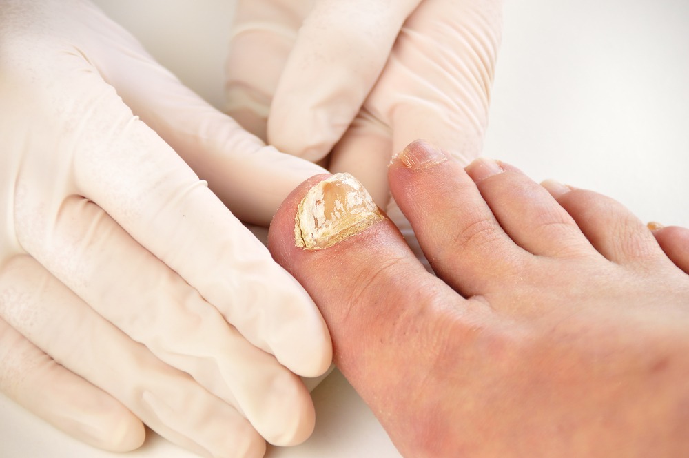 Close-up of a healthcare professional wearing gloves examining a patient's toenail, which shows signs of fungal infection. The image highlights foot care and podiatry practices for treating nail conditions.