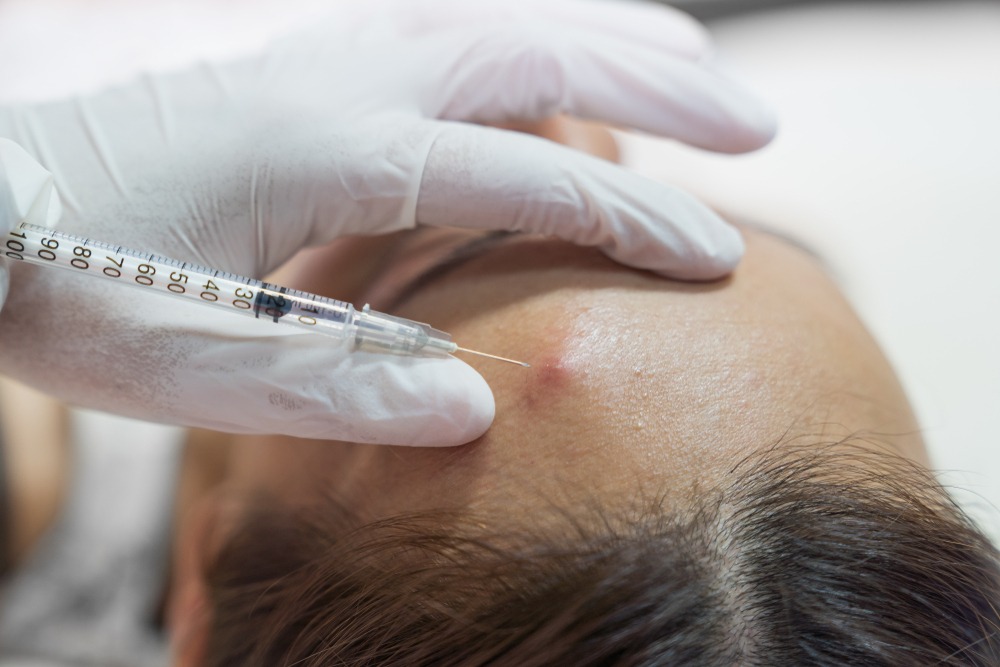 Close-up of a healthcare professional administering an injection to treat a blemish on a patient's forehead, highlighting the use of a syringe and sterile technique.