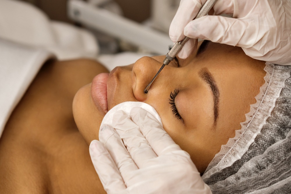How To Treat Acne Scars for Black Skin