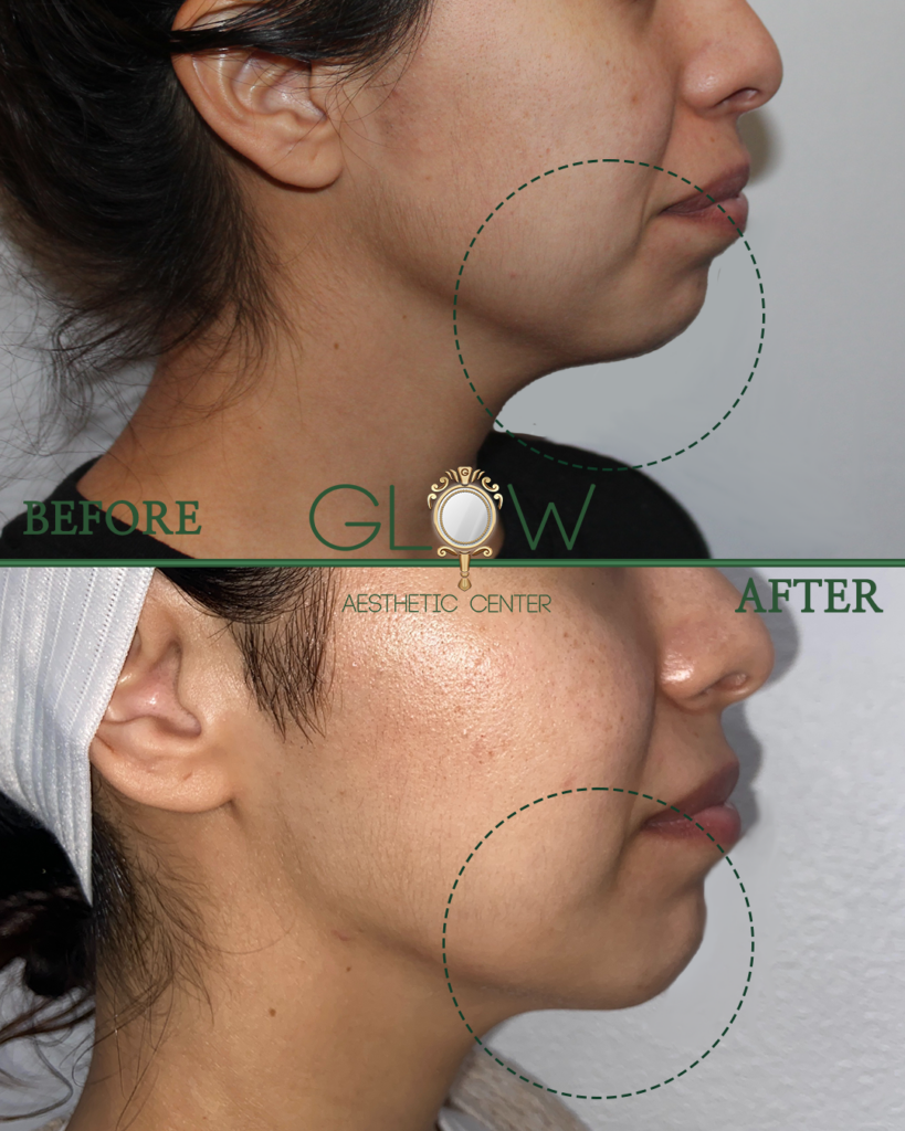 Before and after comparison of a facial aesthetic treatment, highlighting improvements in skin texture and contour on the jawline. The image shows a side profile view, with clear differentiation between the 