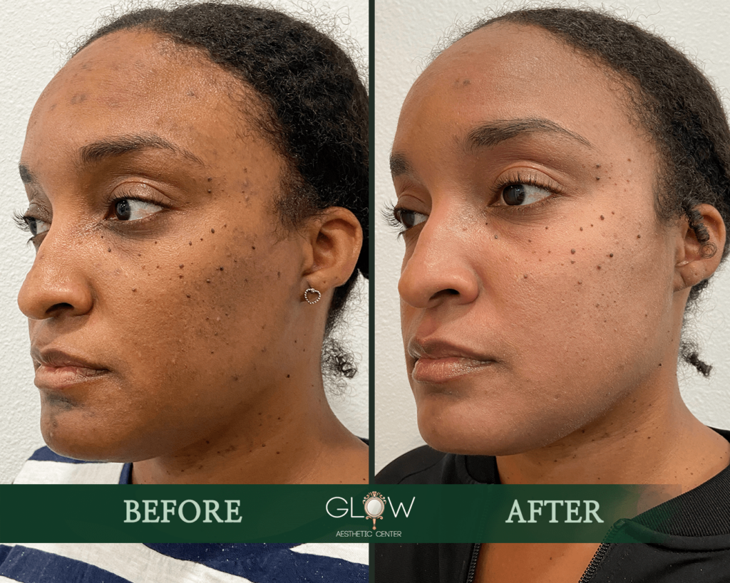 Before and after comparison of a woman's facial appearance, showcasing improved skin texture and clarity following a cosmetic treatment at Glow Aesthetic Center. The left side displays skin with noticeable blemishes, while the right side highlights a smoother and more radiant complexion.