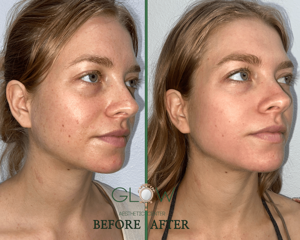 Before and after image showcasing facial aesthetic improvements at Glow Aesthetic Center, highlighting skin texture and tone enhancements. The left side displays the initial condition, while the right side illustrates the results after treatment.