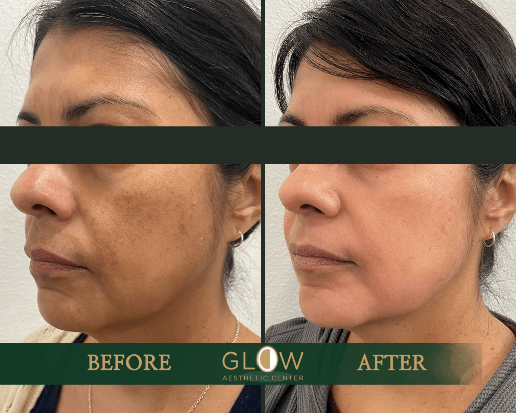Before and after image showcasing facial skin improvement at Glow Aesthetic Center, highlighting reduced hyperpigmentation and enhanced skin texture. The left side displays the skin condition prior to treatment, while the right side illustrates the results post-treatment.