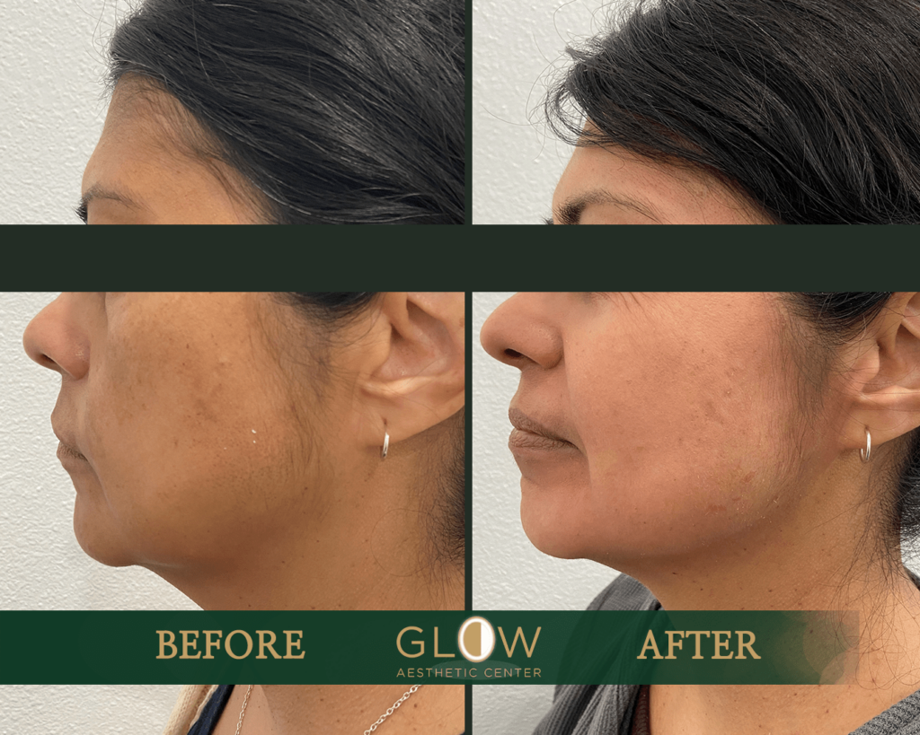 Before and after image showcasing the results of a facial aesthetic treatment at Glow Aesthetic Center. The left side displays the patient's profile before the treatment, highlighting skin imperfections and a less defined jawline. The right side shows the improved appearance after the treatment, featuring smoother skin and a more contoured jawline.