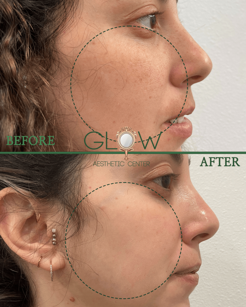 Before and after image showcasing facial aesthetic improvements at Glow Aesthetic Center, highlighting enhanced skin texture and contour.