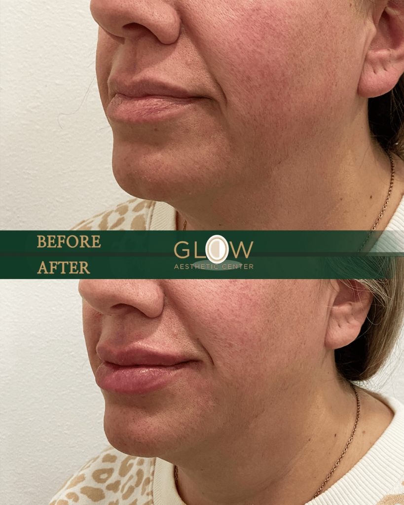 Before and after image showcasing the results of an aesthetic treatment at Glow Aesthetic Center, highlighting improved skin texture and lip fullness.