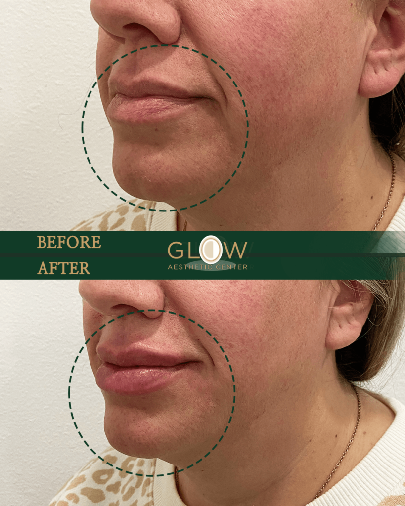 Before and after image showcasing lip enhancement results at Glow Aesthetic Center, highlighting improved volume and smoothness around the mouth area.