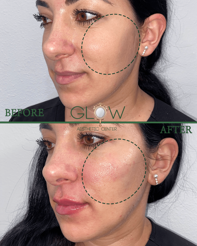 Before and after image showcasing facial aesthetic treatment results at Glow Aesthetic Center, highlighting improved skin texture and appearance in the treated area.