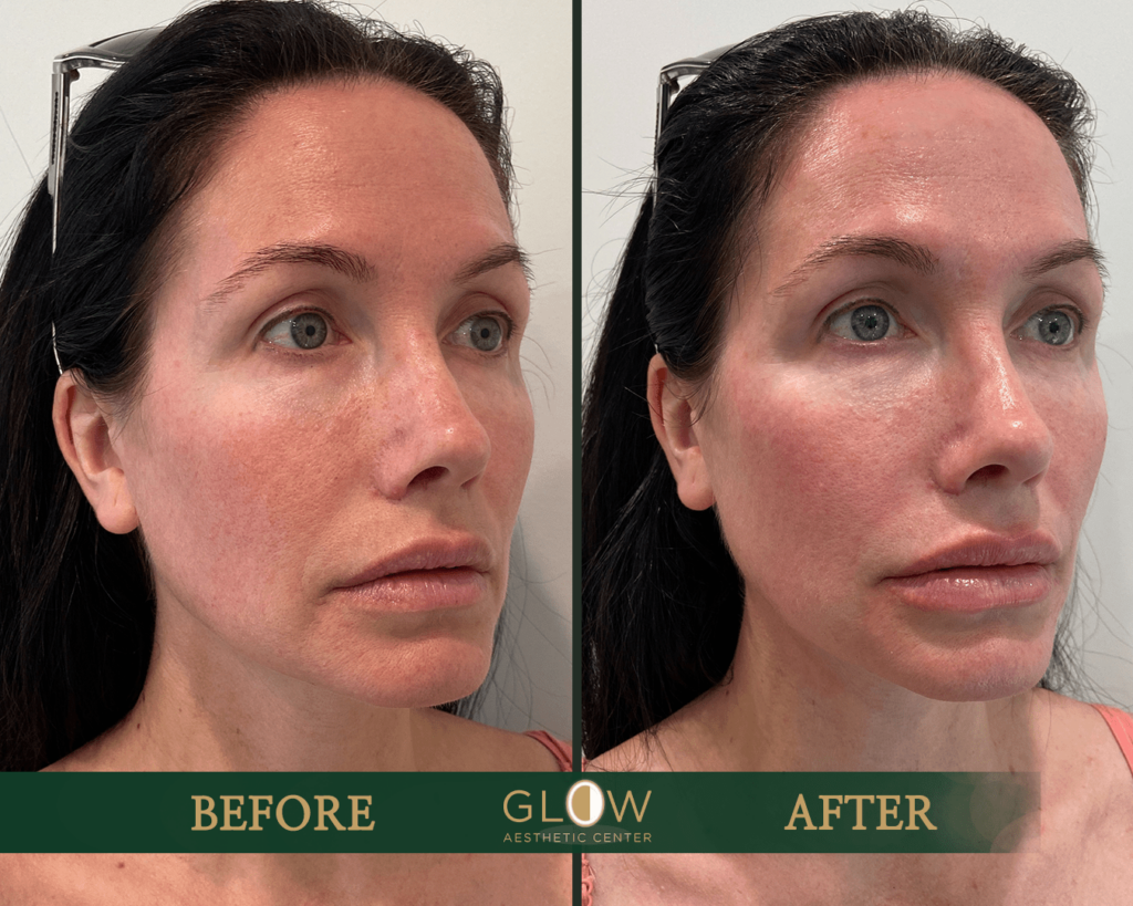 Before and after photo showcasing the results of an aesthetic treatment at Glow Aesthetic Center, highlighting improved skin texture and facial appearance.