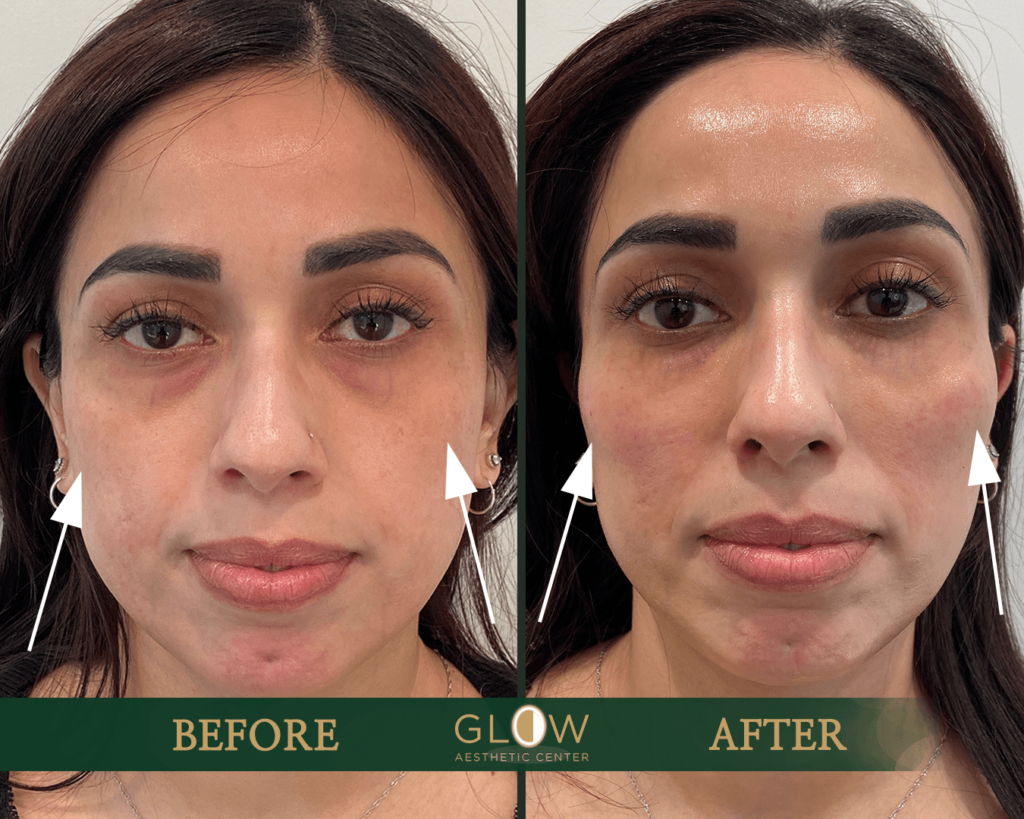Before and after image showcasing the results of an aesthetic treatment at Glow Aesthetic Center, highlighting improved skin texture and reduced under-eye circles. The left side shows the 
