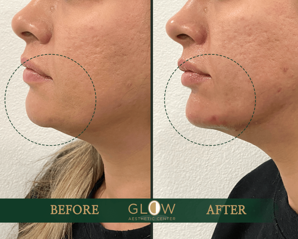Before and after photo showcasing facial skin improvement at Glow Aesthetic Center, highlighting reduced acne scars and smoother skin texture on the chin and jawline area.