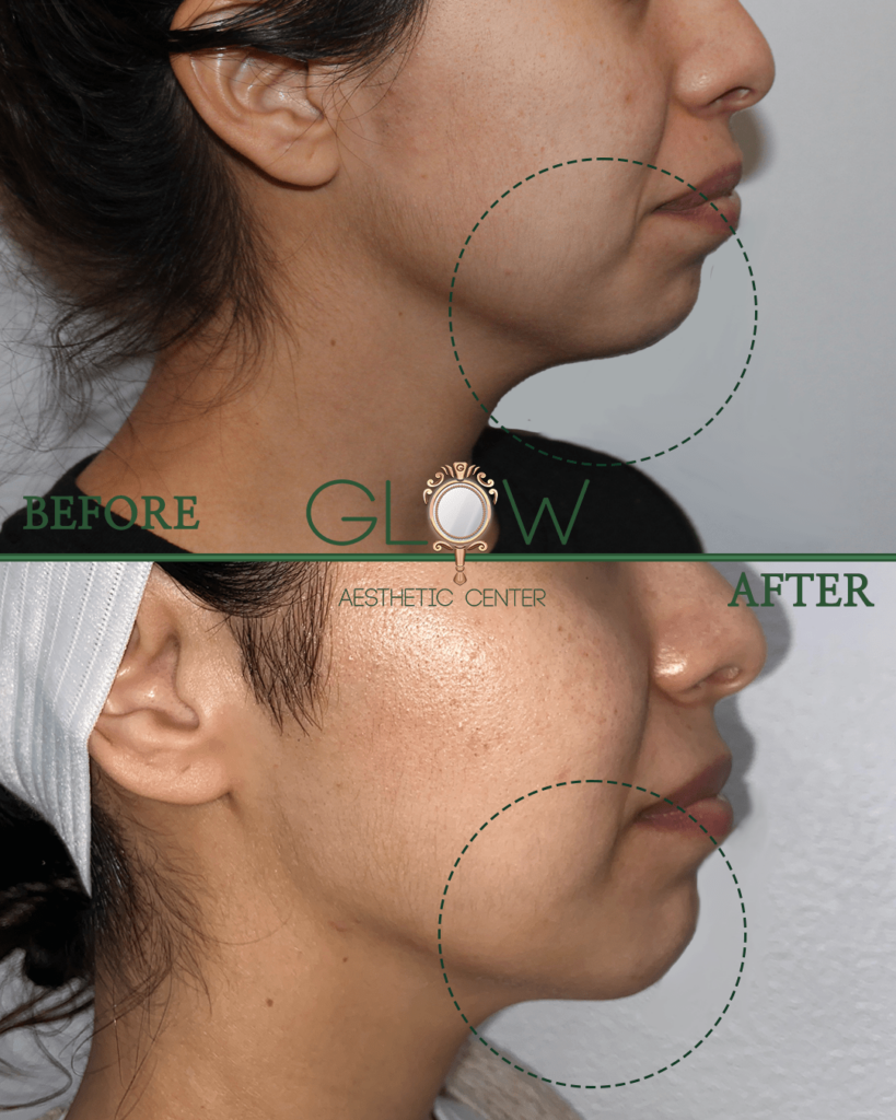 Before and after photo showcasing facial contour improvements at Glow Aesthetic Center, highlighting enhanced jawline definition and skin texture. The top image displays the 