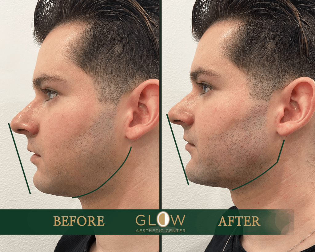 Before and after image showcasing a male client's cosmetic enhancement at Glow Aesthetic Center, highlighting improved facial contours and jawline definition. The left side displays the 