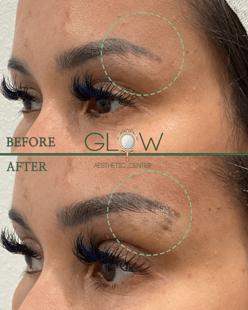 Before and after image showcasing eyebrow enhancement results at Glow Aesthetic Center, highlighting improved shape and definition. The left side displays the natural brow, while the right side illustrates the enhanced appearance with fuller and more polished brows.