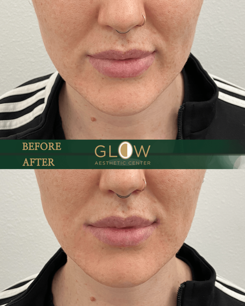 Before and after image showcasing lip enhancement results at Glow Aesthetic Center, highlighting improved lip fullness and contour for a more youthful appearance.