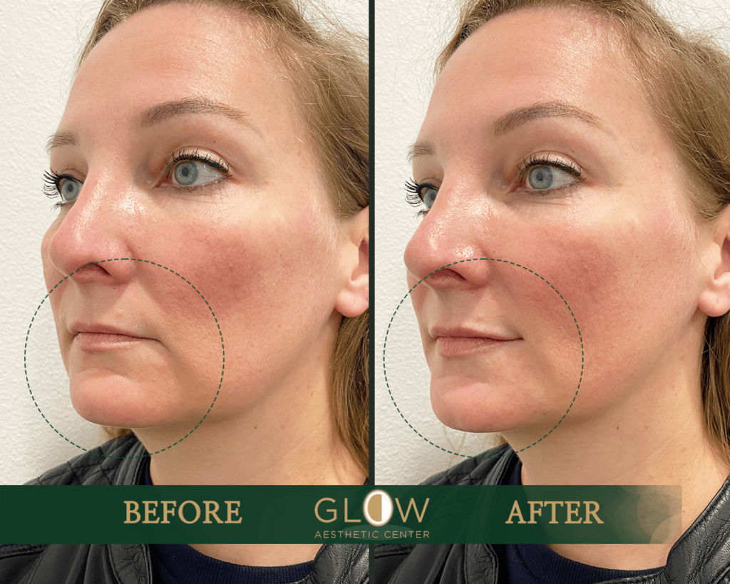 Before and after image showcasing facial aesthetic treatment results at Glow Aesthetic Center, highlighting improved skin texture and contour around the nose and cheeks.