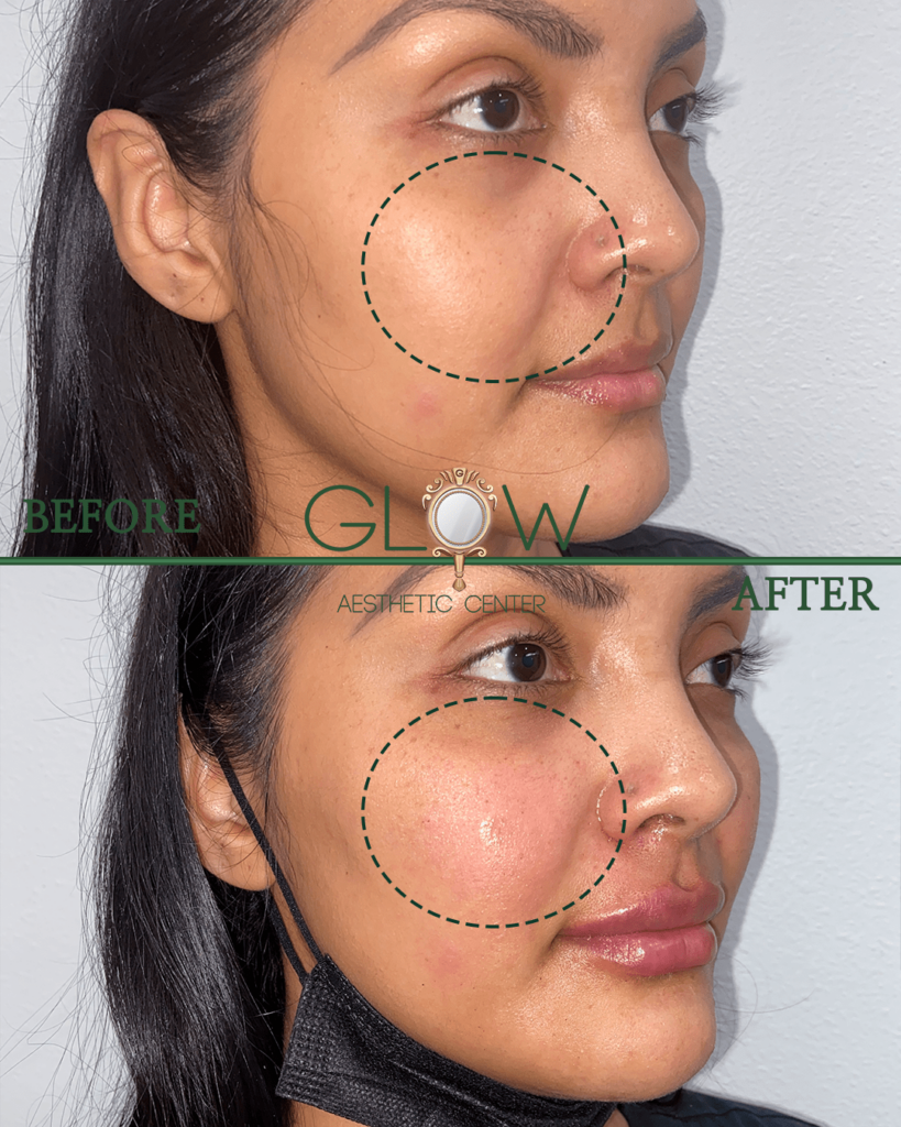 Before and after comparison of facial skin treatment at Glow Aesthetic Center, highlighting improved skin texture and reduced blemishes on the cheek area. The image illustrates significant aesthetic enhancement and rejuvenation results.