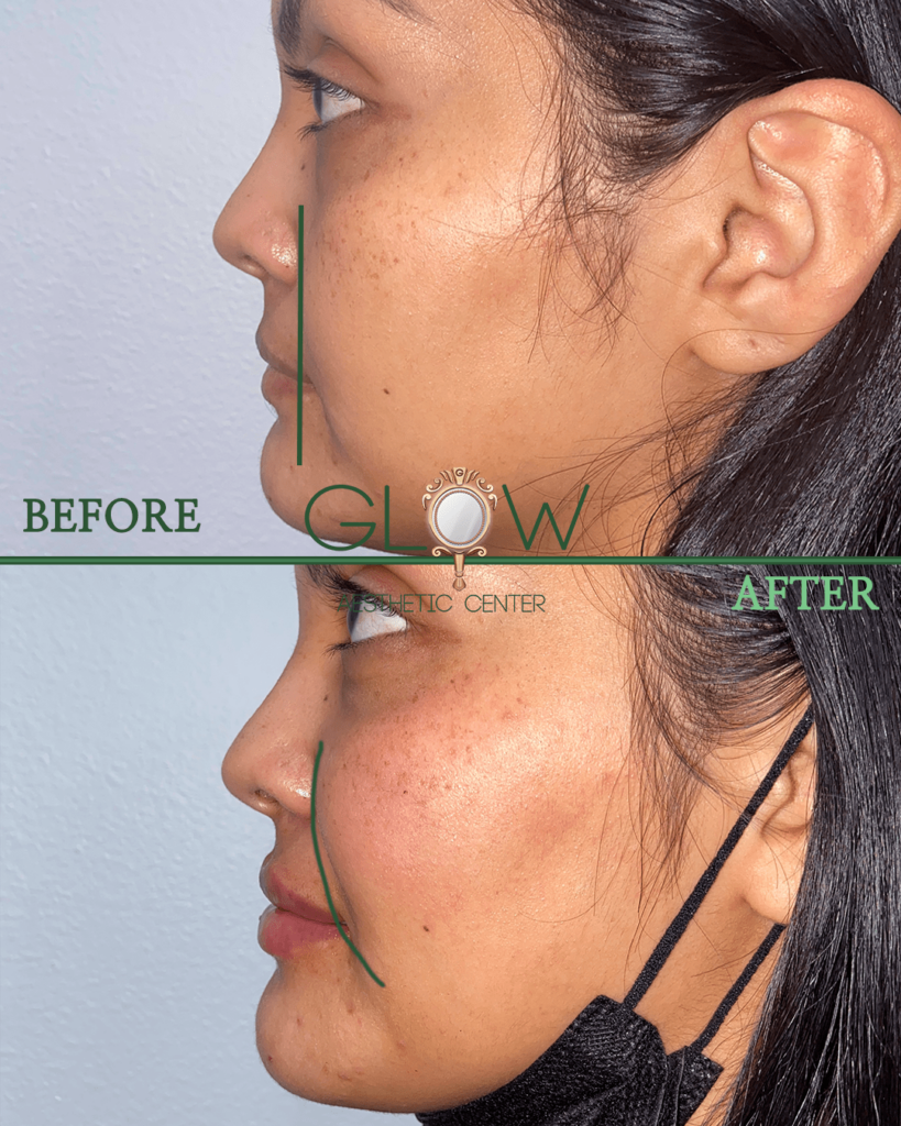 Before and after images showcasing the facial transformation of a client at Glow Aesthetic Center, highlighting improved skin texture and contour. The left side displays the 