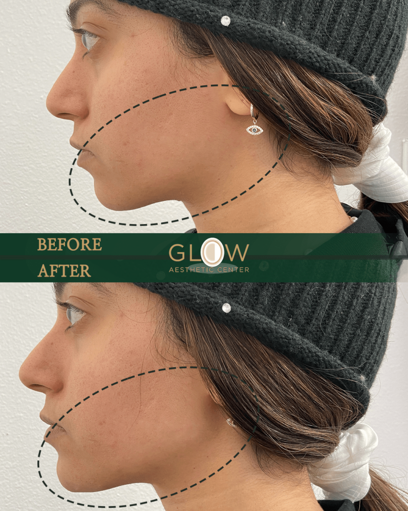 Before and after profile comparison showing facial contouring results at Glow Aesthetic Center, highlighting improvements in jawline definition and overall facial symmetry.