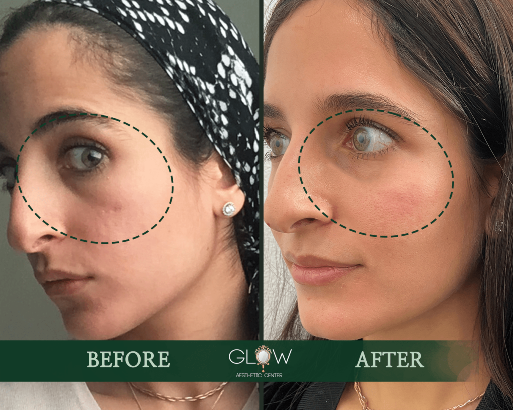 Before and after image showcasing skin improvement at Glow Aesthetic Center, highlighting enhanced facial appearance and reduced blemishes after treatment.