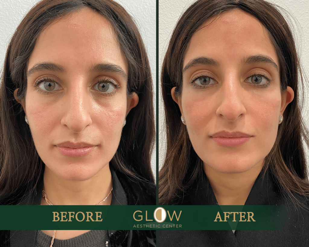 Before and after photo showcasing facial aesthetic treatment results at Glow Aesthetic Center, highlighting improved skin texture and appearance.