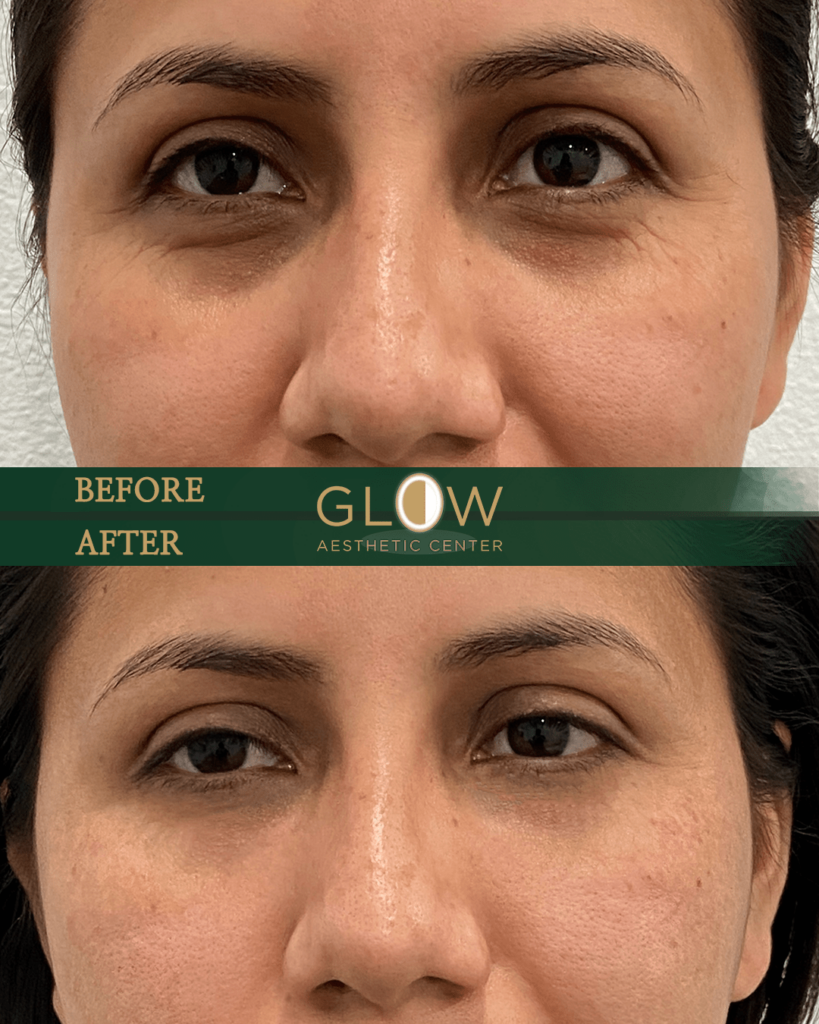 Before and after photo showcasing facial rejuvenation results at Glow Aesthetic Center, highlighting improved skin texture and reduced signs of aging around the eyes.
