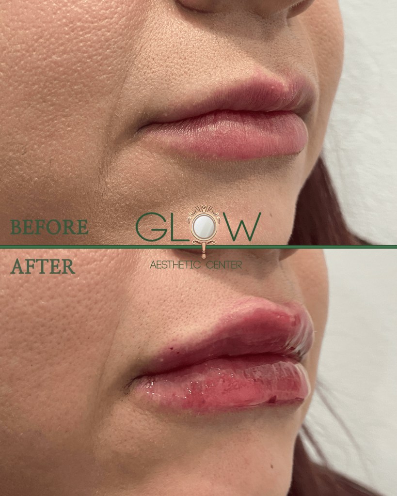 Before and after comparison of lip enhancement treatment at Glow Aesthetic Center, showcasing noticeable volume increase and improved lip definition.