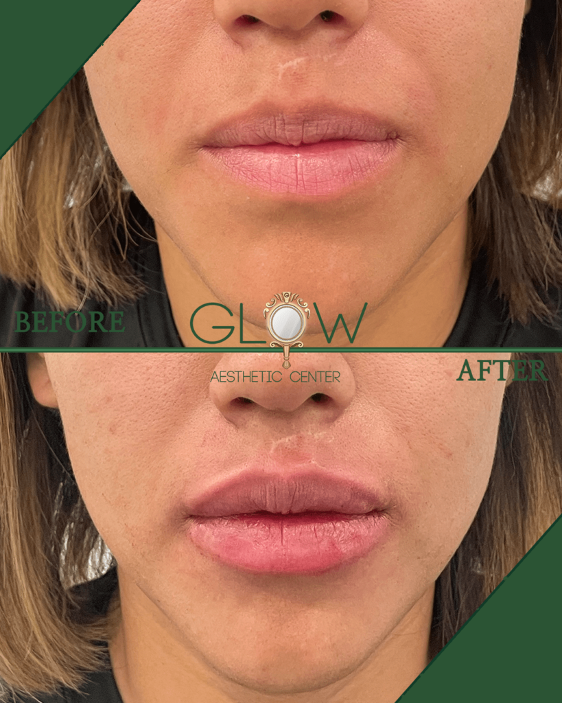 Before and after image showcasing lip enhancement results at Glow Aesthetic Center, highlighting fuller and more defined lips in the after photo.