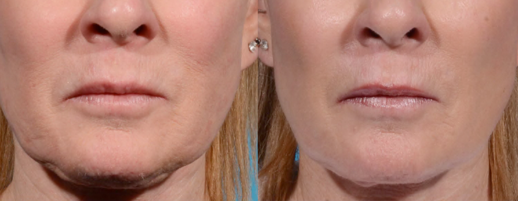 Before and after comparison of facial rejuvenation treatment, highlighting improvements in skin texture and reduction of wrinkles around the mouth and chin area.