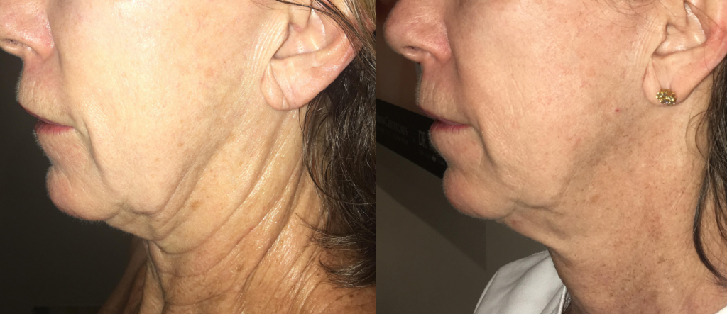 Side-by-side comparison of a woman's neck before and after a cosmetic treatment, highlighting improvements in skin texture and firmness, with reduced sagging and wrinkles.
