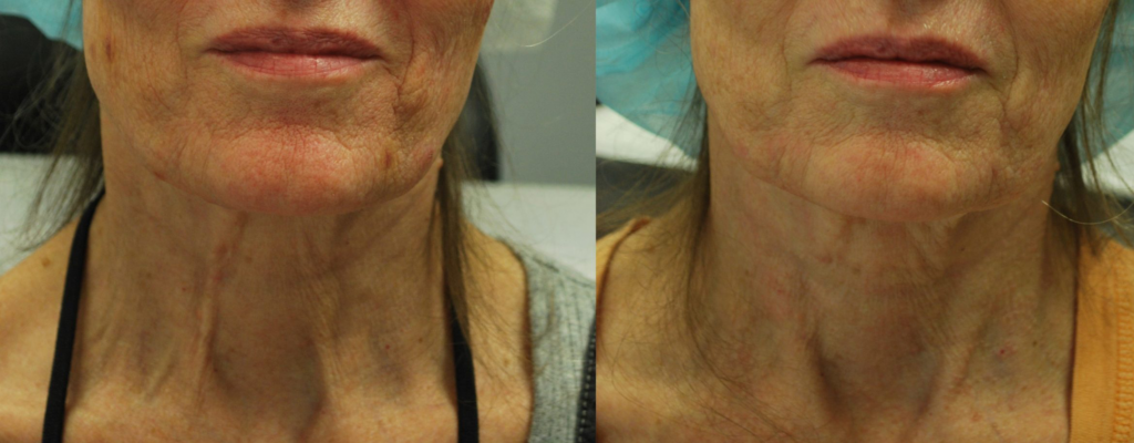 Before and after comparison of a woman's neck and jawline showing signs of aging, highlighting improvements in skin texture and reduction of wrinkles after a cosmetic treatment.